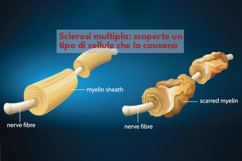 Sclerosi Multipla: scoperte cellule che la causano