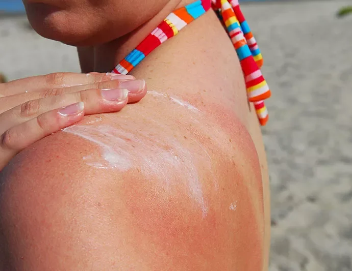 Danni dei raggi UV sulla pelle ispessimento
