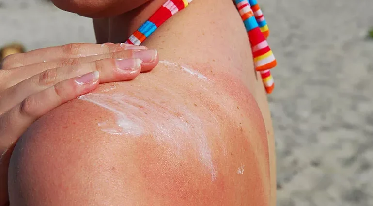 Danni dei raggi UV sulla pelle ispessimento